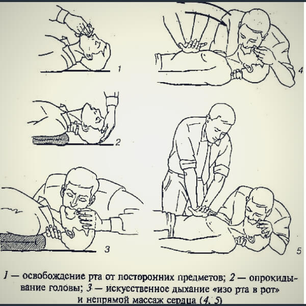 слр сердечный приступ